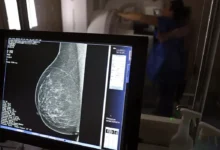 Plano de saúde terá que cobrir mamografia digital para todas as idades
